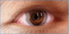 Visione doppia diplopia